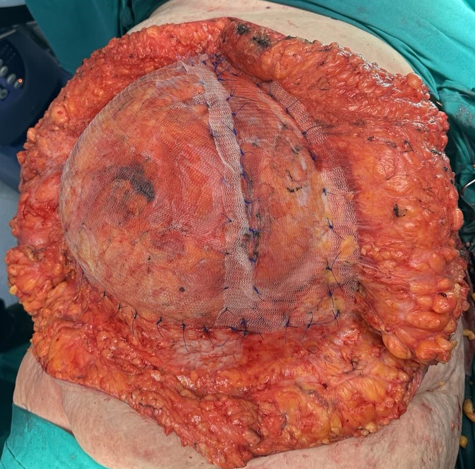 Εκτεθέντες κιρσοί (Ευγενική παραχώρηση Dr. V. Penopoulos)