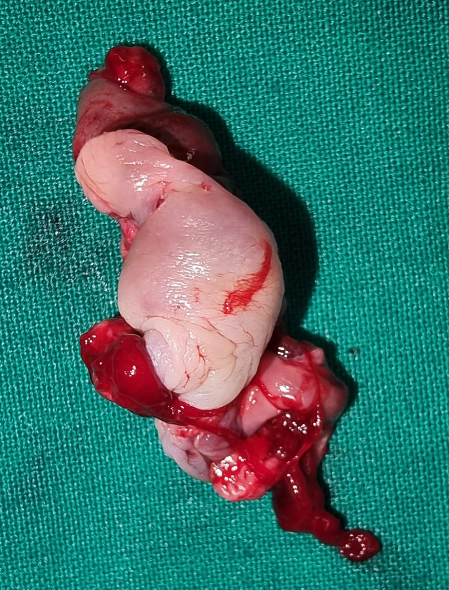 Μακροσκοπική άποψη την 2η μετεγχειρητική ημέρα. Πράσινο περίγραμμα: περιοχή εκτομής αιμορραγούντων κιρσών (Ευγενική παραχώρηση Dr. V. Penopoulos)