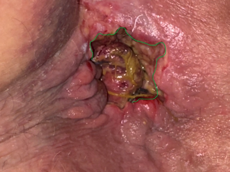 Μακροσκοπική άποψη την 2η μετεγχειρητική ημέρα. Πράσινο περίγραμμα: περιοχή εκτομής αιμορραγούντων κιρσών (Ευγενική παραχώρηση Dr. V. Penopoulos)