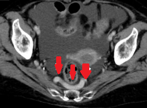 Μαζικές κιρσοί ορθού (Ευγενική παραχώρηση Dr. V. Penopoulos)