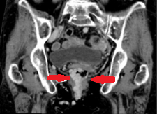 Κόκκινα βέλη: μαζική διάταση της δεξιάς ανώτερης ορθικής φλέβας. Παράπλευρη κυκλοφορία μεταξύ ανώτερων ορθικών φλεβών (κόκκινα βέλη) και ανορθικών κιρσών (κίτρινα και πράσινα βέλη) (Ευγενική παραχώρηση Dr. V. Penopoulos)