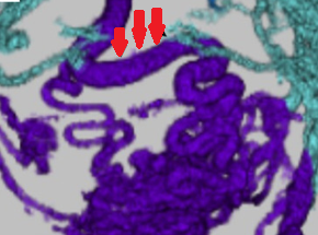 Οισοφαγικοί κιρσοί στις θέσεις ωρολογίου 6 και 9. Κηράσιες κόκκινες κηλίδες στη θέση ωρολογίου 9. Κόκκινες ραβδώσεις στη θέση ωρολογίου 6, καθώς και αιματοκυστικές κηλίδες (Ευγενική παραχώρηση Dr. V. Penopoulos)