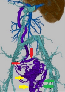 Οισοφαγικοί κιρσοί στη θέση ωρολογίου 2. Παχύ προεξέχον αγγείο επί του κιρσού που αντιπροσωπεύει αιματοκυστική κηλίδα (Ευγενική παραχώρηση Dr. V. Penopoulos)