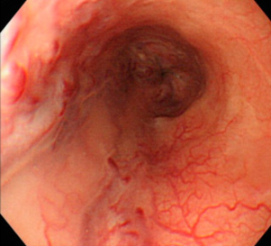 Ανορθικοί κιρσοί (Ευγενική παραχώρηση Dr. V. Penopoulos)