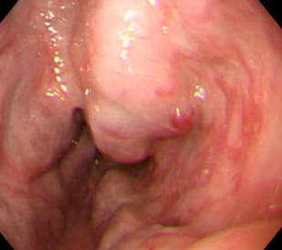 Ανορθικοί κιρσοί. Έντονη διάταση εξωτερικού αιμορροϊδικού φλεβικού πλέγματος, με εμφανή επικοινωνία με το φλεβικό δίκτυο των ορθικών κιρσών. Επισημαίνεται αρχόμενη ρήξη κιρσού στη θέση ωρολογίου 12 (Ευγενική παραχώρηση Dr. V. Penopoulos)