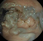 Εκτομή συρριγγώδους πόρου μαζί με κυστικό σχηματισμό υποδόριου λίπους (Ευγενική παραχώρηση Dr. V. Penopoulos)