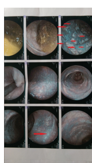 Ενδοσκοπικές εικόνες ιδιοπαθών κιρσών ορθού (Ευγενική παραχώρηση Dr. V. Penopoulos)