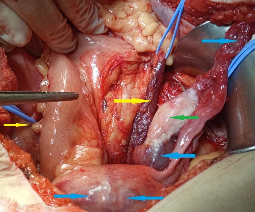 Μακροσκοπική άποψη εκτεθέντος ορθού (Ευγενική παραχώρηση Dr. V. Penopoulos)