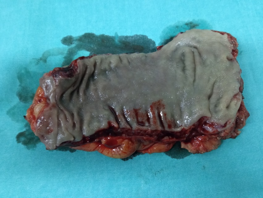 Μακροσκοπική άποψη εκτεθέντος ορθού (Ευγενική παραχώρηση Dr. V. Penopoulos)