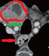 Chest-neck CT. Red outline: enlarged right thyroid lobe. Green arrow: mild pressure on the trachea. Red arrow: downhill esophageal varices (Courtesy Dr. V. Penopoulos)