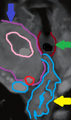 Yellow arrow: dilated venous plexus. Green arrow: trachea. Purple arrow: enlarged right thyroid lobe with central cystic degeneration (Courtesy Dr. V. Penopoulos)