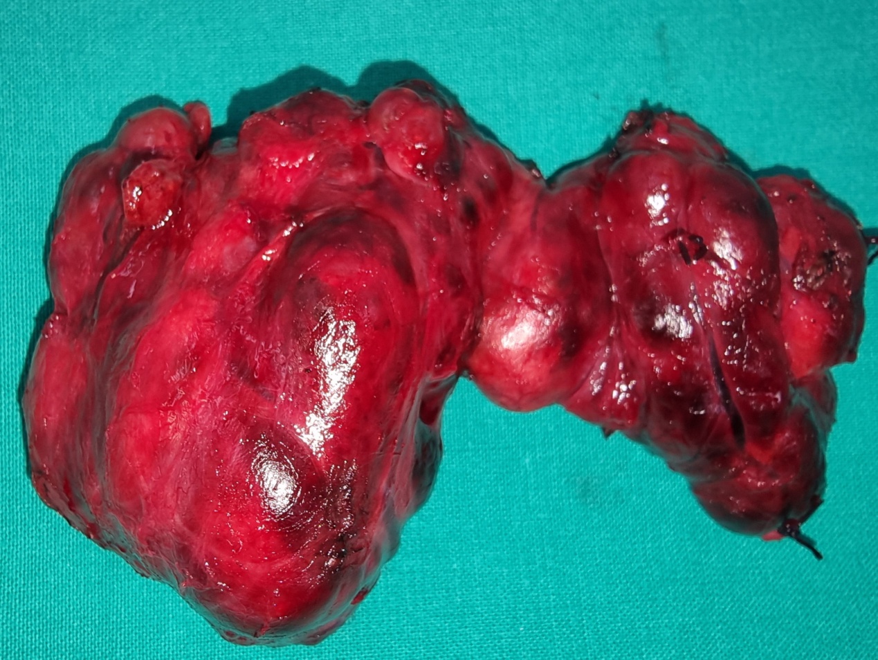 Total thyroidectomy specimen (Courtesy Dr. V. Penopoulos)