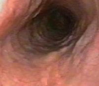 Postoperative endoscopy and chest-neck CT. Complete disappearance of the esophageal varices (Courtesy Dr. V. Penopoulos)