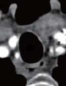 Postoperative endoscopy and chest-neck CT. Complete disappearance of the esophageal varices (Courtesy Dr. V. Penopoulos)