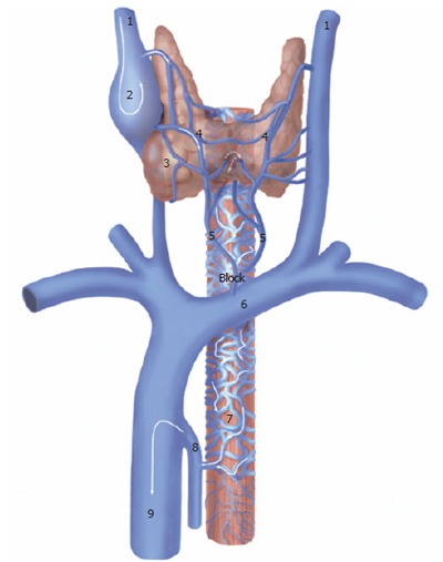 Postoperative endoscopy and chest-neck CT. Complete disappearance of the esophageal varices (Courtesy Dr. V. Penopoulos)