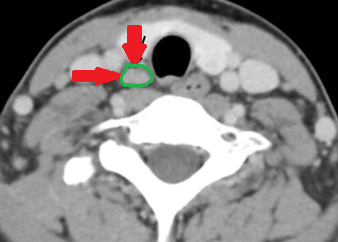 Neck CT scan. Enlarged right inferior parathyroid gland (Courtesy Dr. V. Penopoulos)