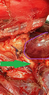 Purple arrow: over-descended large superior parathyroid adenoma. Yellow arrow: normal right inferior parathyroid gland found in the thymothyroid ligament (Courtesy Dr. V. Penopoulos)
