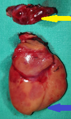 Purple arrow: over-descended large superior parathyroid adenoma. Yellow arrow: normal right inferior parathyroid gland found in the thymothyroid ligament (Courtesy Dr. V. Penopoulos)