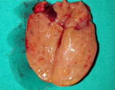 Purple arrow: over-descended large superior parathyroid adenoma. Yellow arrow: normal right inferior parathyroid gland found in the thymothyroid ligament (Courtesy Dr. V. Penopoulos)