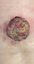 Χρώση αιματοξυλίνης-ηωσίνης. Παρουσία διάσπαρτων άτυπων μιτωτικών φιγούρων, νεκρωτικών νεοπλασματικών κυττάρων και τυπικής σμηγματώδους διαφοροποίησης με κενοτοπιώδες κυτταρόπλασμα και κυματοειδή πυρηνικά περιγράμματα (Ευγενική παραχώρηση Dr. V. Penopoulos)