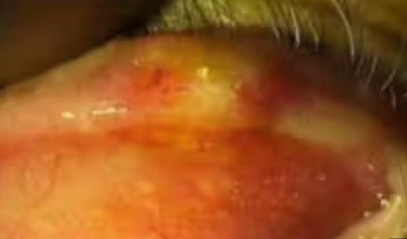 Χρώση αιματοξυλίνης-ηωσίνης. Παρουσία διάσπαρτων άτυπων μιτωτικών φιγούρων, νεκρωτικών νεοπλασματικών κυττάρων και τυπικής σμηγματώδους διαφοροποίησης με κενοτοπιώδες κυτταρόπλασμα και κυματοειδή πυρηνικά περιγράμματα (Ευγενική παραχώρηση Dr. V. Penopoulos)