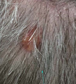 Χρώση αιματοξυλίνης-ηωσίνης. Παρουσία διάσπαρτων άτυπων μιτωτικών φιγούρων, νεκρωτικών νεοπλασματικών κυττάρων και τυπικής σμηγματώδους διαφοροποίησης με κενοτοπιώδες κυτταρόπλασμα και κυματοειδή πυρηνικά περιγράμματα (Ευγενική παραχώρηση Dr. V. Penopoulos)