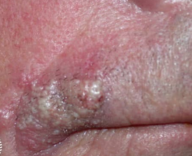 Χρώση αιματοξυλίνης-ηωσίνης. Παρουσία διάσπαρτων άτυπων μιτωτικών φιγούρων, νεκρωτικών νεοπλασματικών κυττάρων και τυπικής σμηγματώδους διαφοροποίησης με κενοτοπιώδες κυτταρόπλασμα και κυματοειδή πυρηνικά περιγράμματα (Ευγενική παραχώρηση Dr. V. Penopoulos)