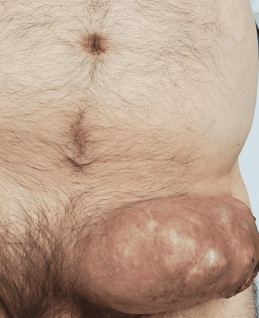 Χρώση αιματοξυλίνης-ηωσίνης. Παρουσία διάσπαρτων άτυπων μιτωτικών φιγούρων, νεκρωτικών νεοπλασματικών κυττάρων και τυπικής σμηγματώδους διαφοροποίησης με κενοτοπιώδες κυτταρόπλασμα και κυματοειδή πυρηνικά περιγράμματα (Ευγενική παραχώρηση Dr. V. Penopoulos)