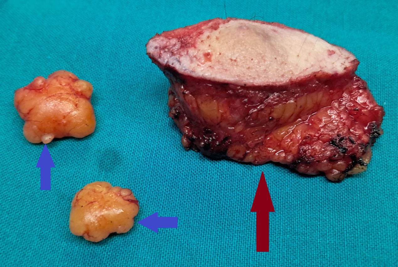 Χρώση αιματοξυλίνης-ηωσίνης. Παρουσία διάσπαρτων άτυπων μιτωτικών φιγούρων, νεκρωτικών νεοπλασματικών κυττάρων και τυπικής σμηγματώδους διαφοροποίησης με κενοτοπιώδες κυτταρόπλασμα και κυματοειδή πυρηνικά περιγράμματα (Ευγενική παραχώρηση Dr. V. Penopoulos)