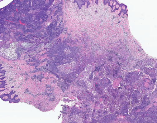 Χρώση αιματοξυλίνης-ηωσίνης. Παρουσία διάσπαρτων άτυπων μιτωτικών φιγούρων, νεκρωτικών νεοπλασματικών κυττάρων και τυπικής σμηγματώδους διαφοροποίησης με κενοτοπιώδες κυτταρόπλασμα και κυματοειδή πυρηνικά περιγράμματα (Ευγενική παραχώρηση Dr. V. Penopoulos)