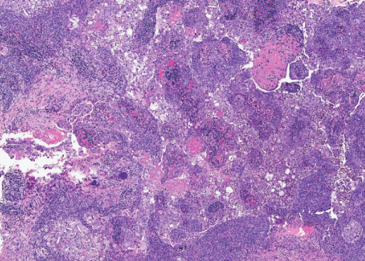 Χρώση αιματοξυλίνης-ηωσίνης. Παρουσία διάσπαρτων άτυπων μιτωτικών φιγούρων, νεκρωτικών νεοπλασματικών κυττάρων και τυπικής σμηγματώδους διαφοροποίησης με κενοτοπιώδες κυτταρόπλασμα και κυματοειδή πυρηνικά περιγράμματα (Ευγενική παραχώρηση Dr. V. Penopoulos)