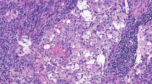Χρώση αιματοξυλίνης-ηωσίνης. Παρουσία διάσπαρτων άτυπων μιτωτικών φιγούρων, νεκρωτικών νεοπλασματικών κυττάρων και τυπικής σμηγματώδους διαφοροποίησης με κενοτοπιώδες κυτταρόπλασμα και κυματοειδή πυρηνικά περιγράμματα (Ευγενική παραχώρηση Dr. V. Penopoulos)
