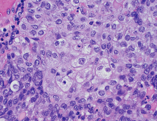 Χρώση αιματοξυλίνης-ηωσίνης. Παρουσία διάσπαρτων άτυπων μιτωτικών φιγούρων, νεκρωτικών νεοπλασματικών κυττάρων και τυπικής σμηγματώδους διαφοροποίησης με κενοτοπιώδες κυτταρόπλασμα και κυματοειδή πυρηνικά περιγράμματα (Ευγενική παραχώρηση Dr. V. Penopoulos)