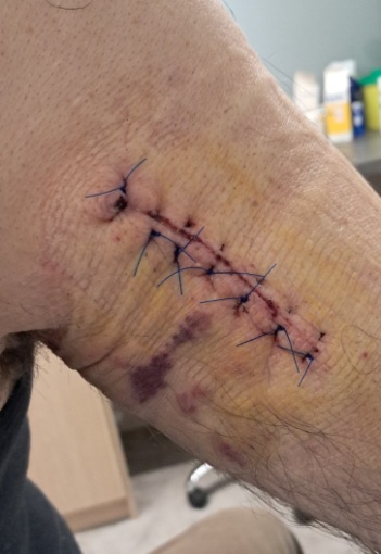 Μωβ βέλη: λιπώματα. Καφέ βέλος: αδενοκαρκίνωμα σμηγματώδους αδένα (Ευγενική παραχώρηση Dr. V. Penopoulos)