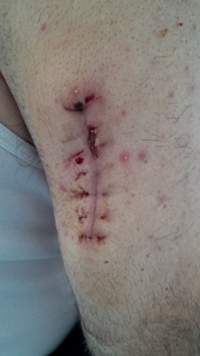 Μωβ βέλη: λιπώματα. Καφέ βέλος: αδενοκαρκίνωμα σμηγματώδους αδένα (Ευγενική παραχώρηση Dr. V. Penopoulos)