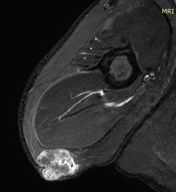 Μωβ βέλη: λιπώματα. Καφέ βέλος: αδενοκαρκίνωμα σμηγματώδους αδένα (Ευγενική παραχώρηση Dr. V. Penopoulos)