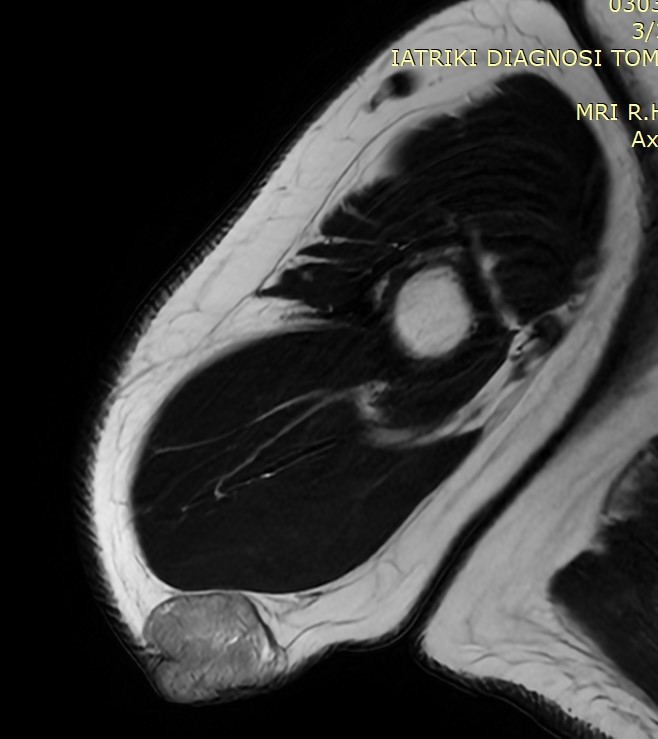 Χρώση αιματοξυλίνης-ηωσίνης. Στιβάδες/πλάκες και οζίδια διηθητικών βασαλοειδών βλαστικών κυττάρων, με περιοχές πλακώδους διαφοροποίησης, νέκρωσης και εστιακά ουδετεροφιλικά μικροαποστήματα (Ευγενική παραχώρηση Dr. V. Penopoulos)