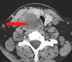 Neck CT scan. Parathyroid carcinoma (Courtesy Dr. V. Penopoulos)