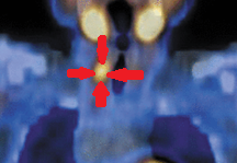 PET scan. Findings consistent with parathyroid carcinoma (Courtesy Dr. V. Penopoulos)