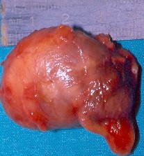 Surgical specimen of parathyroid carcinoma (Courtesy Dr. V. Penopoulos)