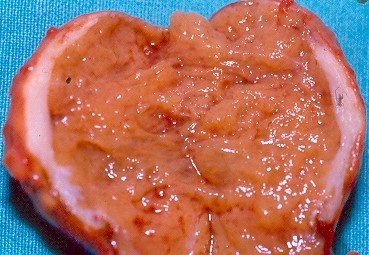 Histopathological examination of parathyroid adenocarcinoma (Courtesy Dr. V. Penopoulos)