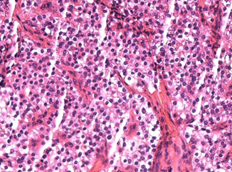 Histopathological examination of parathyroid adenocarcinoma (Courtesy Dr. V. Penopoulos)