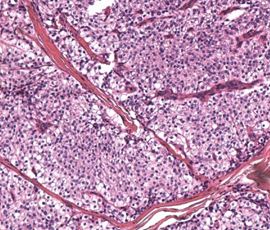 Histopathological examination of parathyroid adenocarcinoma (Courtesy Dr. V. Penopoulos)
