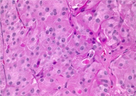 Total thyroidectomy specimen (Courtesy Dr. V. Penopoulos)