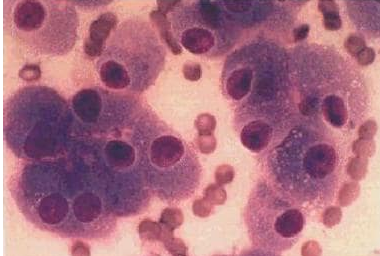 Vascular invasion by Hürthle cell carcinoma cells (Courtesy Dr. V. Penopoulos)