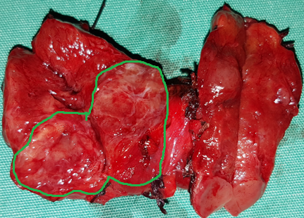 Vascular invasion by Hürthle cell carcinoma cells (Courtesy Dr. V. Penopoulos)
