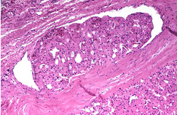 Vascular invasion by Hürthle cell carcinoma cells (Courtesy Dr. V. Penopoulos)