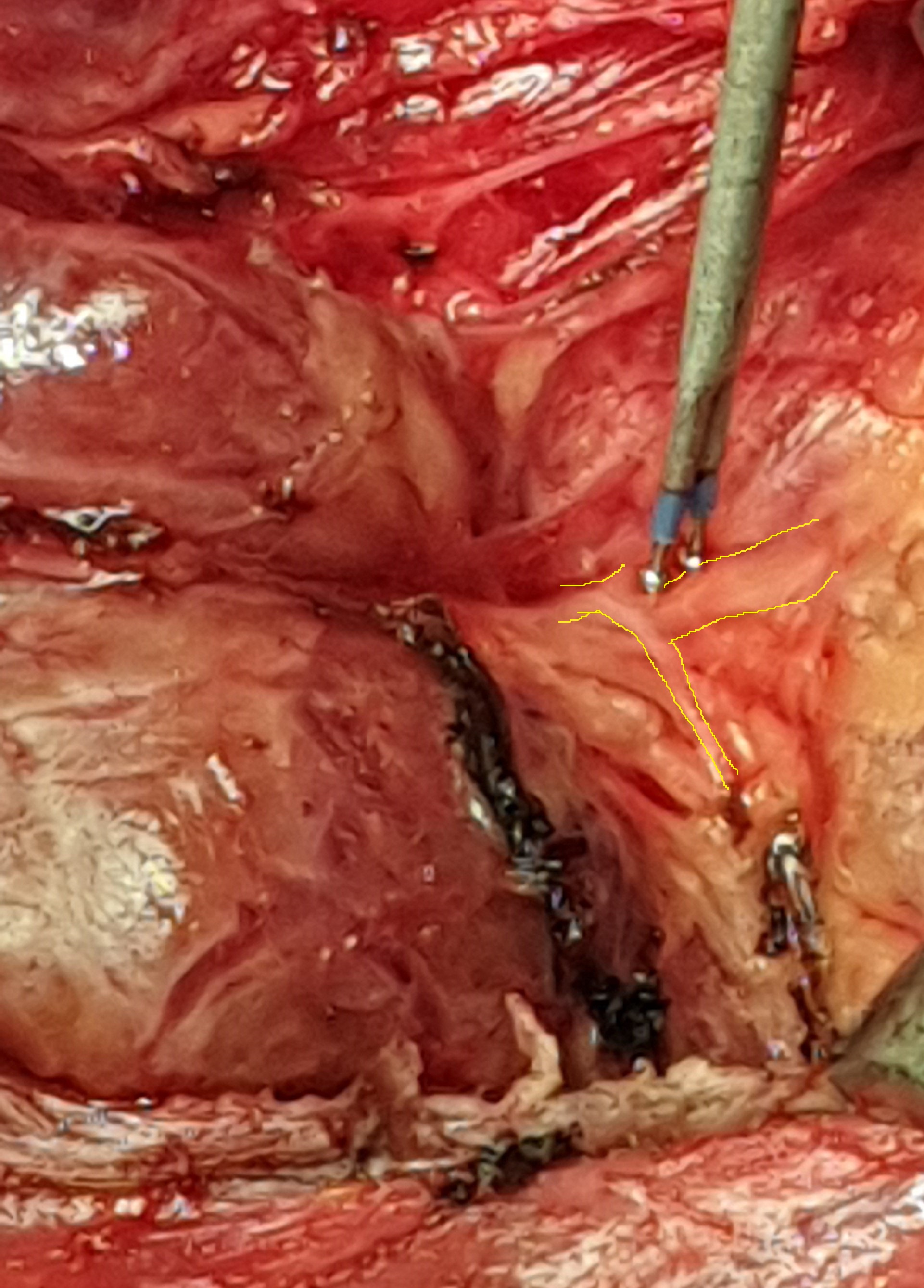 Identification and protection of the recurrent laryngeal nerve. Outline of the nerve — application of the nerve stimulator (Courtesy Dr. V. Penopoulos)