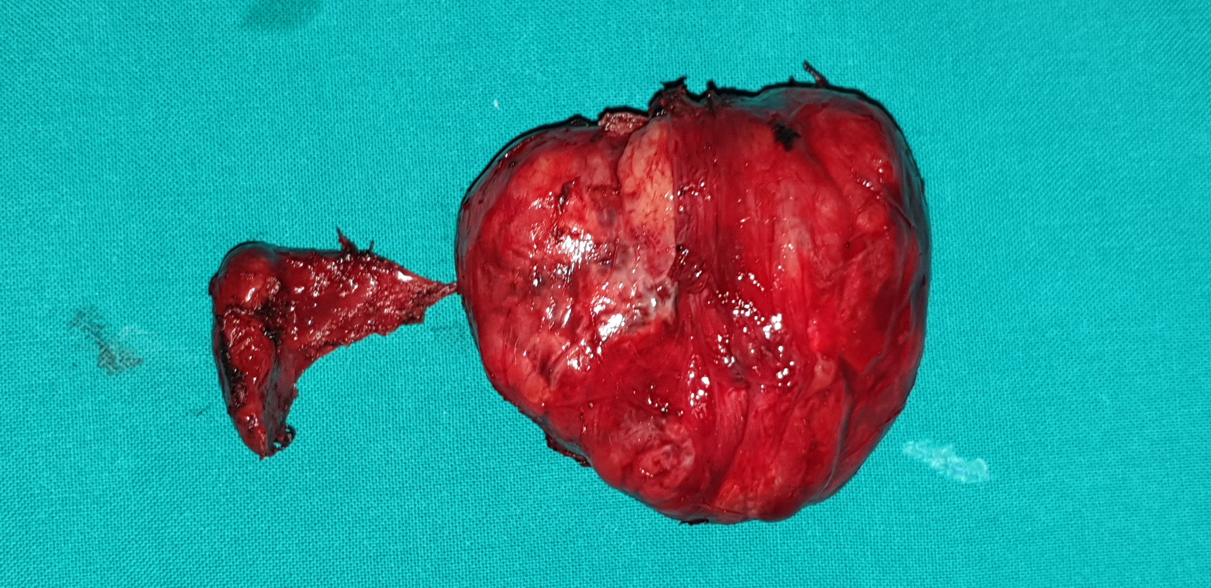 Surgical specimen after total thyroidectomy (Courtesy Dr. V. Penopoulos)