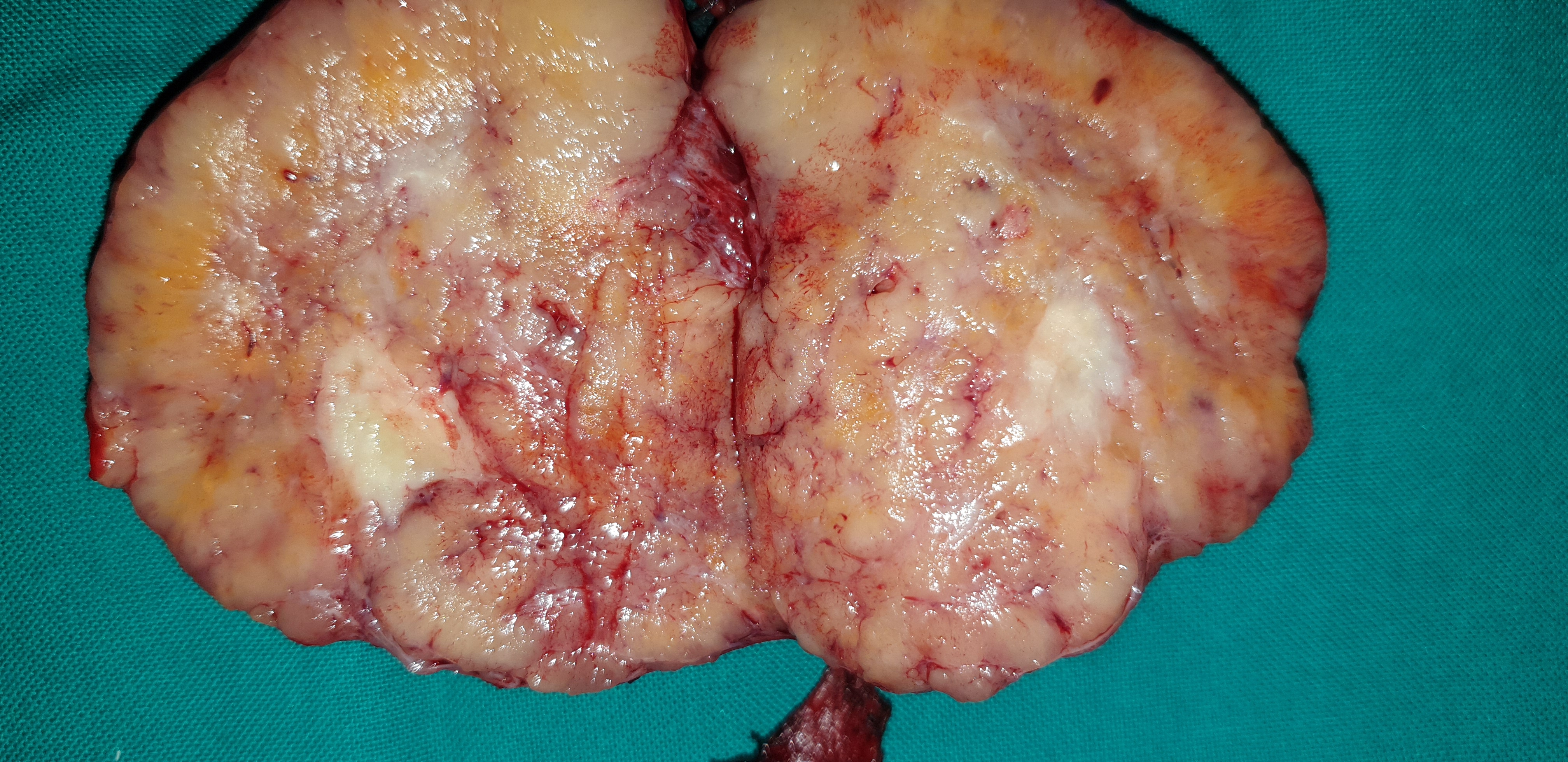 Cross section of the surgical specimen. Areas of necrosis are evident (Courtesy Dr. V. Penopoulos)